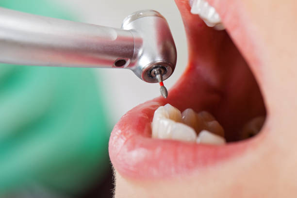 Best Emergency Wisdom Teeth Removal in Spring Hill, TN